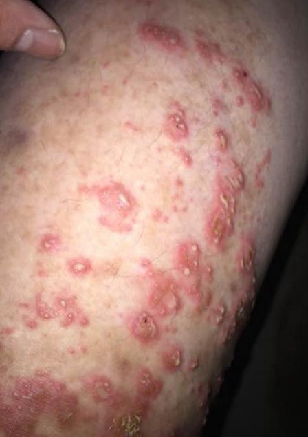 湿疹瘙痒无比破坏肌肤教你一个好办法排毒去湿湿疹好了