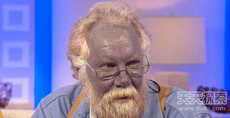 揭美国神秘"蓝脸人":犹如"蓝精灵"