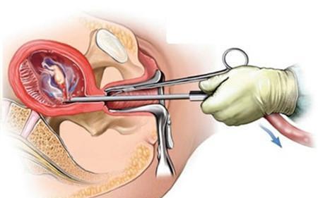 女人流产打掉的孩子胎儿也无痛吗看完你还敢流产吗