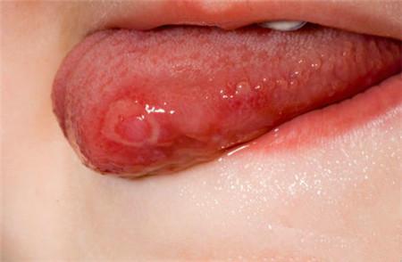 吃饭控制不住咬舌头,如果咬伤该怎么办?