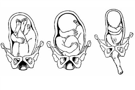 胎位倒置当妊娠高血压疾病较为严重时,会出现胎盘功能低下,胎儿缺氧等