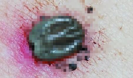 5岁的女儿总说屁股疼,仔细检查立马去医院,原来如此