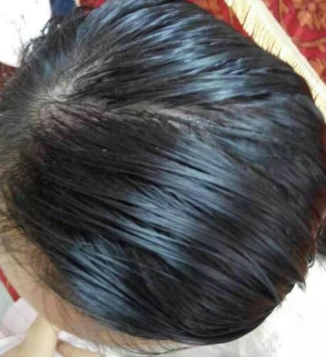 头发油头皮屑多无非这2个原因找到原因即可用这方法去屑