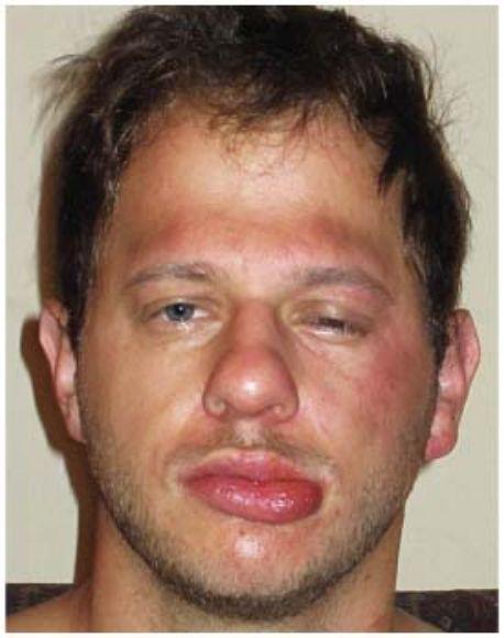 可能有人会质疑:芒果过敏这么吓人吗,还是为了影片效果?