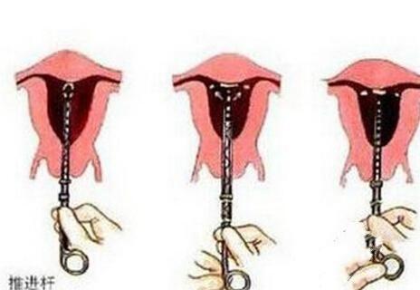 女性结扎竟然这么多危害!