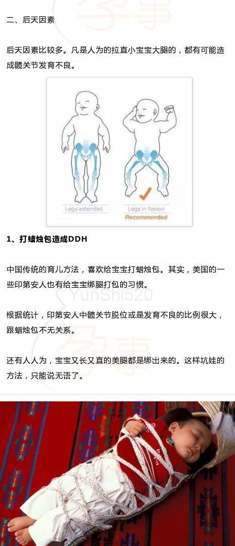 臀纹不对称这事儿也是大事儿1岁之前就得看要不然就晚了