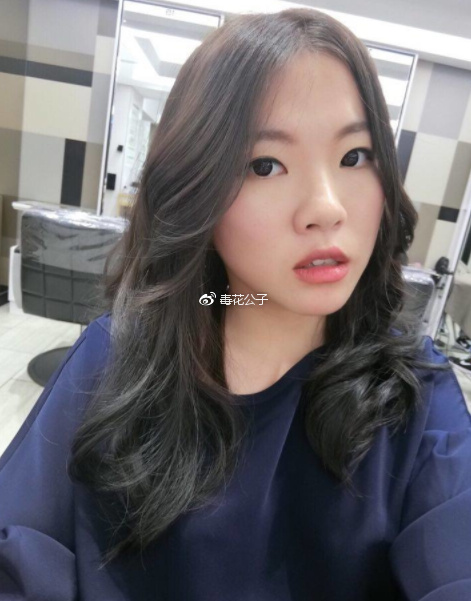 北京埋线双眼皮手术28天 前后对比恢复过程