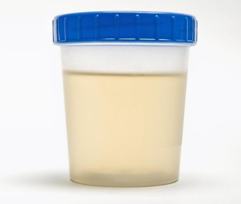 乳白色尿由于尿中红血球被大量破坏所致,也可能是急性肾炎,急性黄疸型