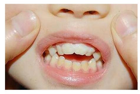 牙科医生:孩子牙齿矫形最好在这个年龄,小儿正形的三个黄金期!