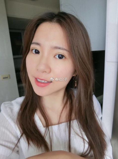 北京埋线双眼皮手术28天 前后对比恢复过程