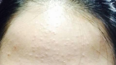 要怎么才能看清楚这些微粉刺呢?