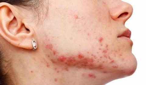 腮边长痘是什么情况?|腮边|淋巴|面部|肝胆|颈部_新浪新闻