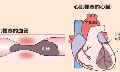 心内科主任 这7种症状 是猝死前兆