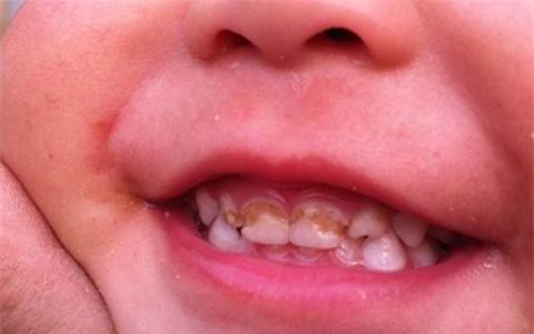 明明是一个可爱帅气的3岁小萌娃, 可一张开嘴却有些雷人了|宝宝|龋齿