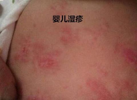 婴儿湿疹和热疹的区别 牢记六大区别不再混淆!
