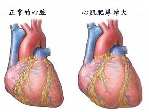 肾挛缩图片