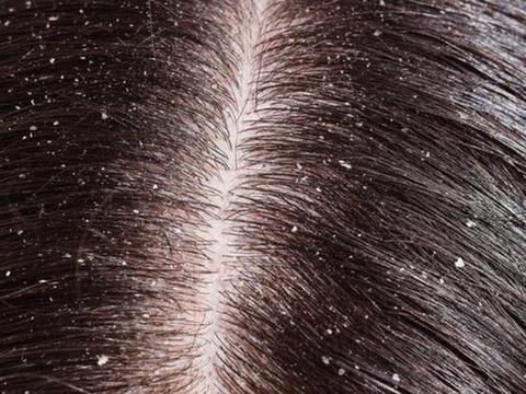 除菌洗发水改善头屑头痒 马拉色菌头皮问题怎么办