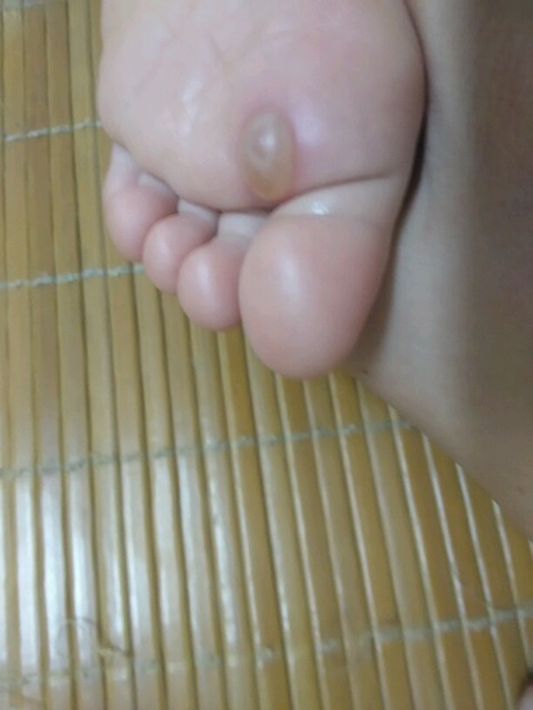 男子买海鲜后发现脚上起水泡,去医院检查,医院告知只能截肢治疗