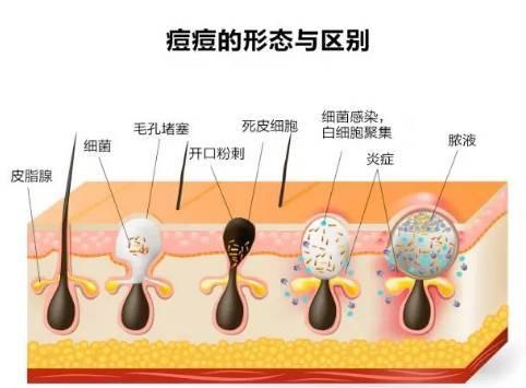 轻彩课堂—那些肉眼看不见的潜在“痘痘”