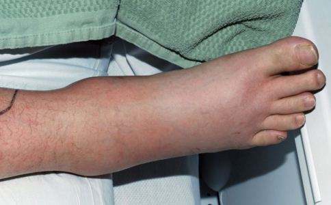 23岁小伙感冒老不好查出尿毒症这6个早期症状早发现早重视