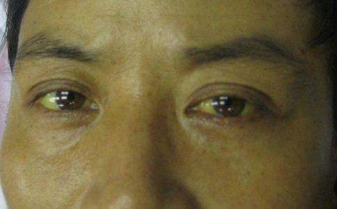 身体出现这4个变化,是脂肪肝正在向肝硬化过渡,越早看到越好!