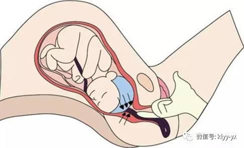 子宫颈管长2厘米左右,是连接阴道和子宫腔的肌性管道