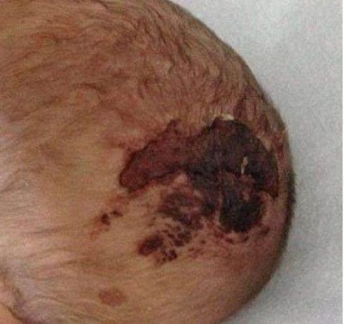 过程中,因女婴不在正常位置而无法顺产,医生多次尝试用真空吸管及产钳