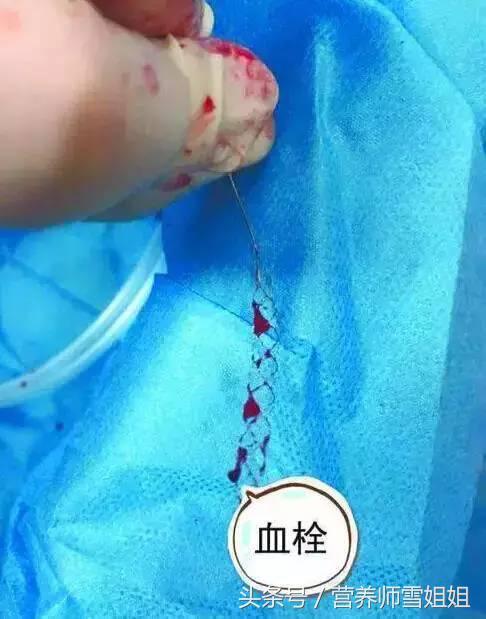 四类人易被血栓"拴住",2个动作"冲洗"血管