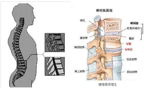 人体腰间盘突出位置图图片