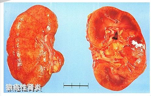 肾内科主任尿毒症是怎么引起的这7种病会悄悄变成尿毒症