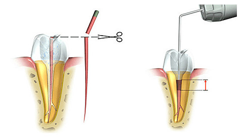 "把根留住", 让牙齿保留"存在感" !