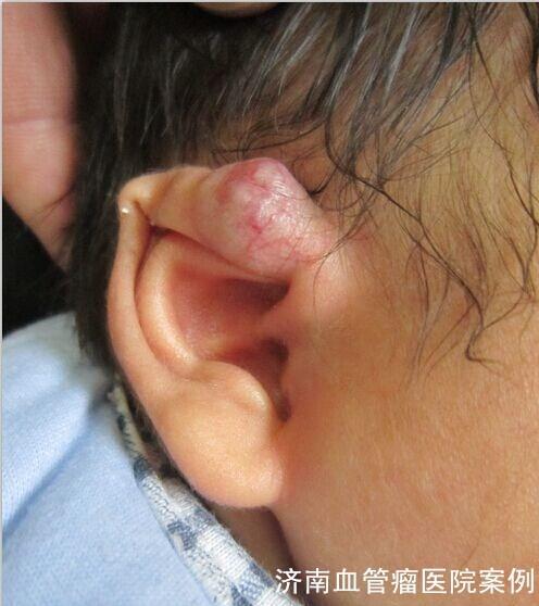 详解外耳廓血管瘤