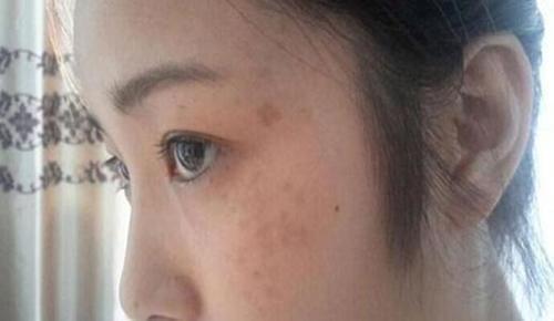 单纯敷面膜并不能淡斑!