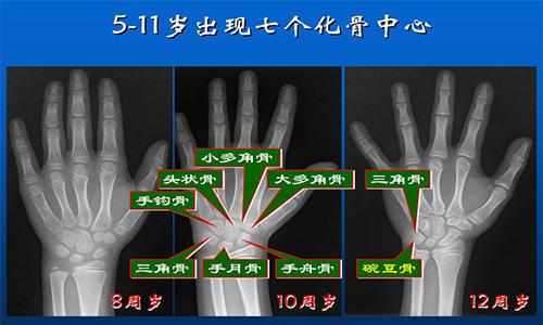 很久没长高, 是不是骨骺线闭合了?