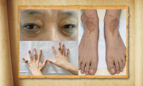 当胆固醇过高时,有的人皮肤上会鼓起小肿块,其表面光滑,呈黄色,多长在