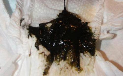 胃癌|桂花茶|信号_新浪新闻