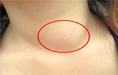 这种癌症偏爱青中年女性有这几种症状女性朋友要当心