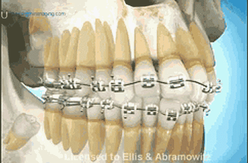 牙齿矫正为什么要拔牙?