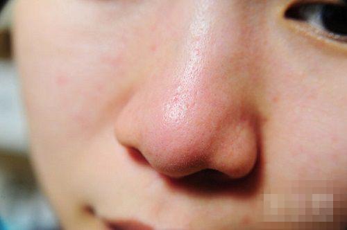 鼻头发红肝脏是身体代谢的重要器官,当肝脏出现问题的时候,身体的内