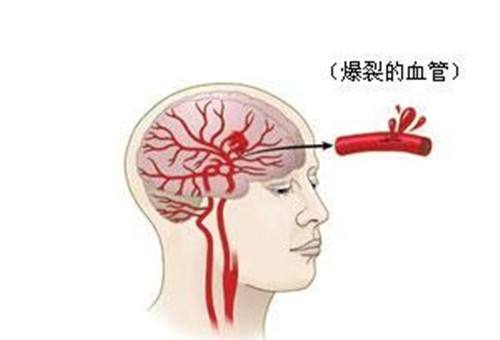 高血压万万别碰这几种食物,当心血压飚升,脑血管破裂就晚了