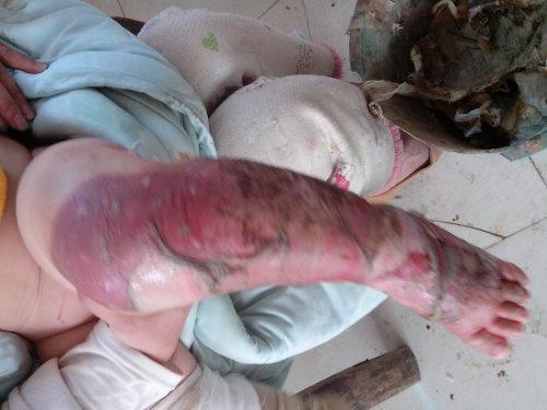 宝宝烫伤后,农村妈妈用偏方治疗,孩子的状况让她彻底傻眼!