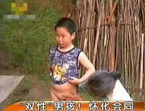 离奇10岁小孩长男女双套生殖器官成双性人