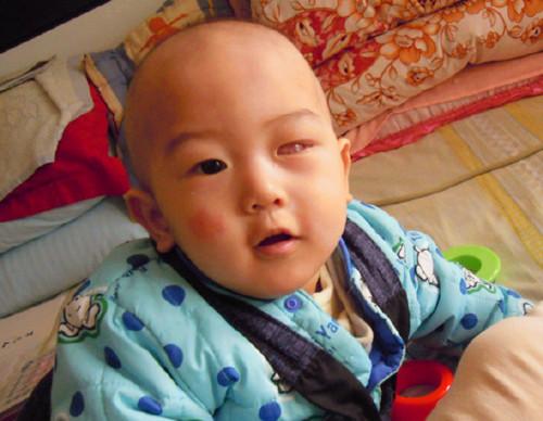 宝宝眼红流眼泪,妈妈以为是红眼病,没想到却让孩子成了独眼龙