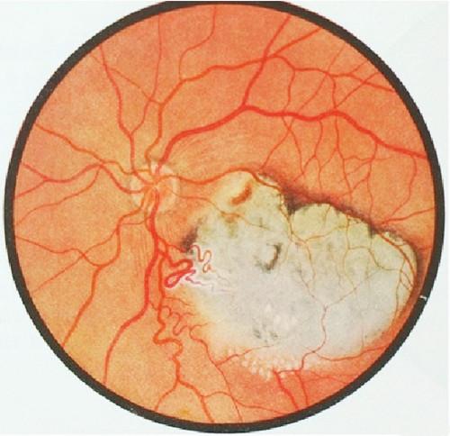 宝宝眼红流眼泪,妈妈以为是红眼病,没想到却让孩子成了独眼龙