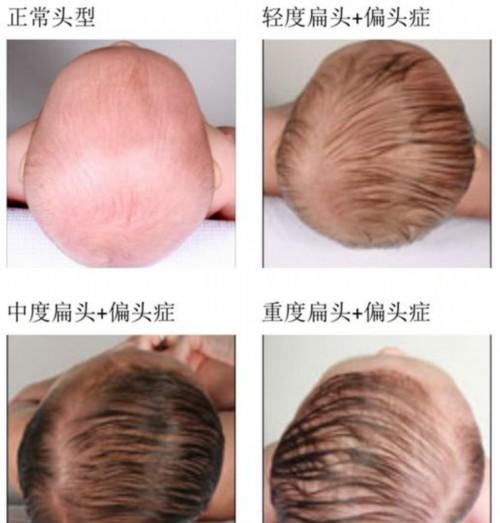 婴儿期睡姿影响颜值