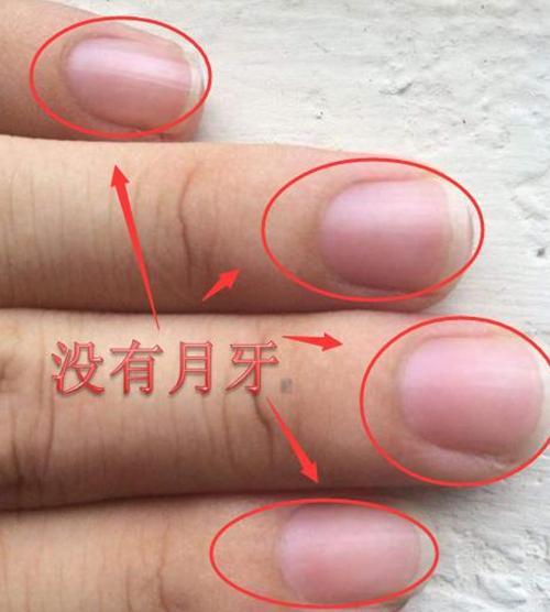 医生忠告手指月牙有这几个特征一定是身体遭受疾病了
