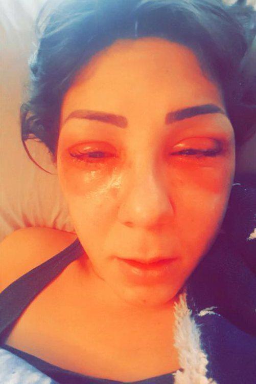 25岁女孩用完睫毛增长剂, 第二天醒来眼睛差点变瞎