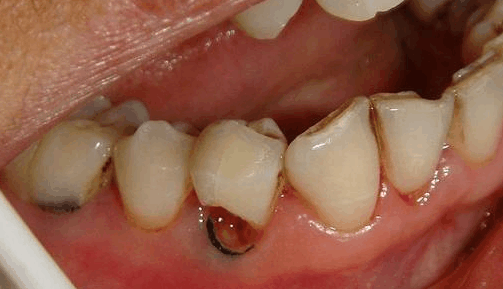 平时都在好好刷牙 怎么牙根却开始烂掉了|牙根|根部|牙冠_新浪网