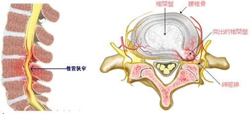 腰间盘突出天然的克星,白酒和它一用,击败腰疼最有效,5天见效|腰椎间
