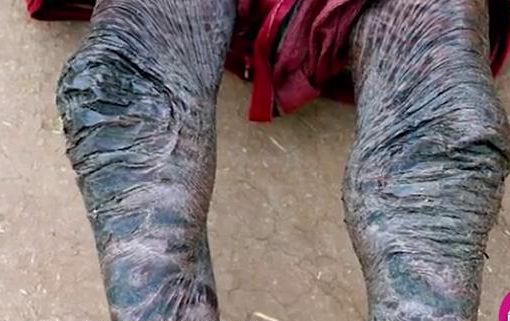 印度恐怖蛇人,每10天蜕一次皮,陌生人不敢接近!